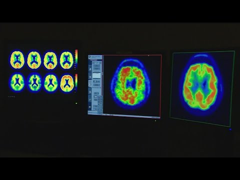 FDA approves new Alzheimer’s treatment