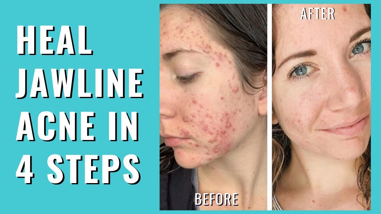 Jawline Acne - CLEAR CYSTIC ACNE ON JAWLINE FAST